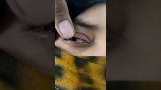 eye infection motivation opthalmology cataracttreatment automobile opthalmic eyesurgery news [upl. by Sellma]