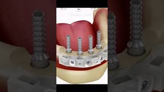 Dental Implants Over Dentures [upl. by Yelknirb]