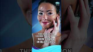 MELASMA VS VITILIGO  PYNOCARE PHILIPPINES [upl. by Enirual]