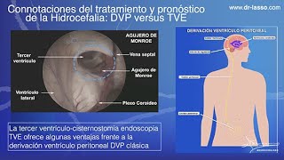 Tercerventriculostomia endoscopica vs derivacion ventriculo peritoneal en hidrocefalia [upl. by Trauts464]