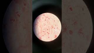 Gram Staining of Sputum Abundant Pus Cells with Absence of Microbial Involvement [upl. by Ennaesor382]