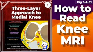 Fig 3A01 ThreeLayer Approach to Medial Knee [upl. by Laaspere]