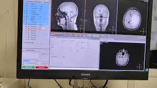 functionalMRIDiffusiontensorimaging navigationBrocaWernickearea avnishradiology [upl. by Ing]