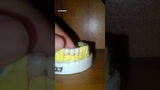 Ceramics And Metal capshortvideo dental teeth new [upl. by Zehc333]