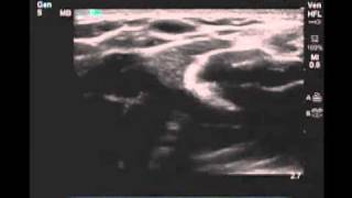 How To Peripheral Arm Veins for Vascular Access Scanning Technique Video [upl. by Manas]