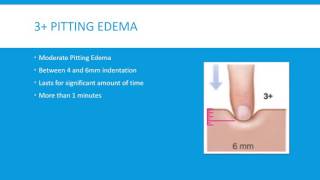 Pitting Edema Grading Scale 4 Levels [upl. by Kantor122]