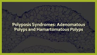 Polyposis Syndromes Adenomatous Polyps and Hamartomatous Polyps [upl. by Chas]