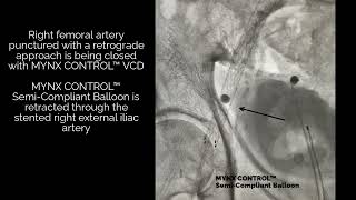 MYNX CONTROL™ VCD Semi Compliant Balloon under fluoroscopy [upl. by Nelo]