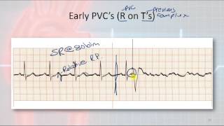 Basic Electrophysiology part 9  Ventricular Rhythms [upl. by Aenit]