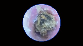 Tympanic membrane perforation and postoperative debridement for cholesteatoma 28 [upl. by Edyaj]