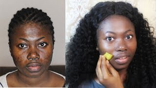 I RUBBED BANANA PEEL ON MY FACE AND MY ACNE PIMPLES VANISHED [upl. by Dnomrej]