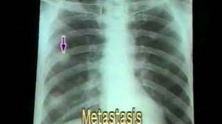 31 Bronchogenic Carcinoma  Chest XRays  Dr Vaidya [upl. by Boles]