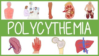 Polycythemia Clinical Features Management and Mnemonics [upl. by Sender469]