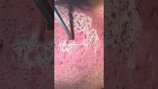 The best way to remove scars PERMANENTLY 🌸 skincare beauty skincaretips [upl. by Trammel800]