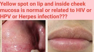 yellow spot on lipwhat to doFordyces granules in cheek related to HIV or HPV or Herpes infection [upl. by Leirud]