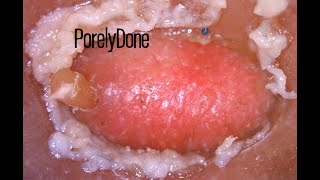 Week3 S2 PorelyDone Pore Blackhead and Oil Vacuum Suction Removal [upl. by Morgenthaler916]