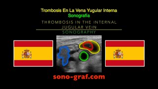 Sonografía  Trombosis En La Vena Yugular Interna [upl. by Anyel241]