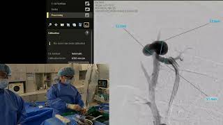 Pulmonary arteriovenous malformation embolization with plugs and coils 폐동정맥기형색전술 [upl. by Lombardi626]