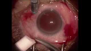 Vitrectomie pelage pour membrane epimaculaire  Vitrectomy for epiretinal membrane [upl. by Cogn]