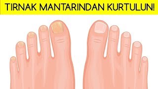 TIRNAK MANTARINDAN KURTULMANIN 5 DOĞAL YÖNTEMİ [upl. by Eidahs]