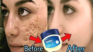 In 3 Days  Remove DARK SPOTS BLACK SPOTS amp ACNE SCARS  Vaseline Hacks  Home Remedies [upl. by Virginia157]