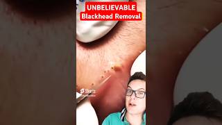 Stunning LIP BLACKHEAD REMOVAL  Biggest Blackheads Ever shorts [upl. by Ahtnahc836]