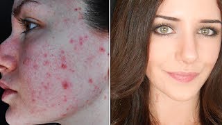 How To Cover Acne amp Scars IF You Want To  Easy Makeup Transformation Routine [upl. by Leumas]