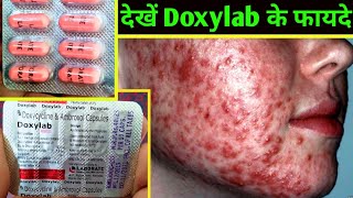 Doxylab Capsules  Doxycycline amp Ambroxol Capsules uses or side effects in Hindi [upl. by Bohannon56]