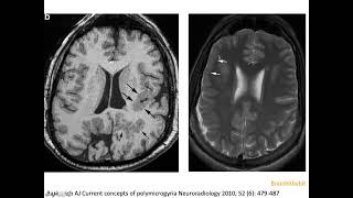 9 Polymicrogyria PMG cortical malformation post migratory glial limiting membrane neuroimaging [upl. by Deehahs]