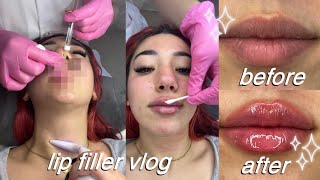 getting lip injections for the first time russian lip filler vlog  full healing process [upl. by Herman708]