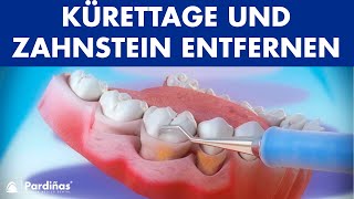 Parodontosebehandlung  Kürettage und Zahnstein entfernen © [upl. by Nnaeinahpets]