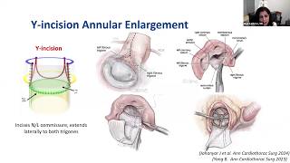 STS Webinar The Future of SAVR August 8 2024 [upl. by Eliseo903]