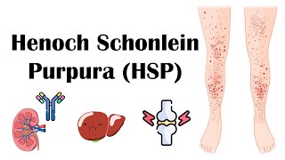 Henoch Schoenlein Purpura HSP  Causes Pathophysiology Diagnosis And Treatment [upl. by Howlend731]