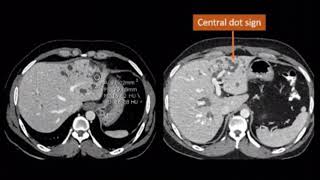 Caroli disease [upl. by Netsirhc]