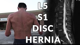 My L5 S1 Disc Hernia Miracle Cure When Physical Therapy Is Just Not Working [upl. by Anrehs]