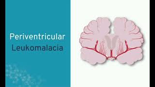 PVL Periventricular leukomalacia mrcpch Communication [upl. by Hcire]