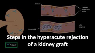 Hyperacute rejection of a kidney graft [upl. by Lothair]