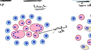 GENERAL PATHOLOGY 36  Tissue reactions in different types of granulomas DR SAMEH GHAZY [upl. by Noami]