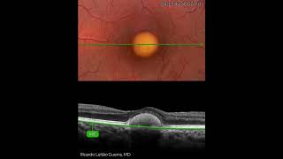 Vitelliform Dystrophy  Multimodal Imaging Analysis [upl. by Certie]