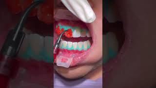 Whitening Procedure In Office FAST and SIMPLE [upl. by Nnylrefinnej]