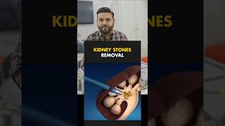 Kidney Stones  Renal Calculus lithotripsyPCNLhealth shorts [upl. by Nirrak993]