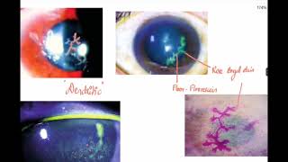 Corneal ulcerKeratitisClinical Ophthalmology [upl. by Aihsas]