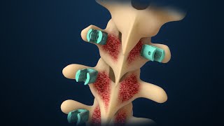 Scoliosis  Scoliosis Surgery  Nucleus Health [upl. by Eissac]