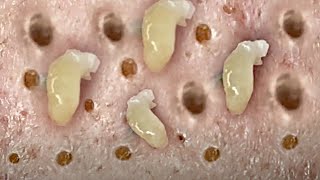 Perfectly Remove Blackheads on Face 002 [upl. by Araiek]