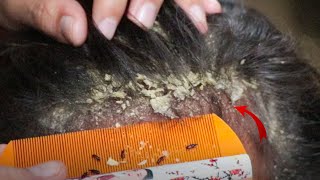 Removed Hundred of Lice From Head and Dry Scalp Huge Dandruff of Flakes Removal With Comb  1765 [upl. by Betthezul]