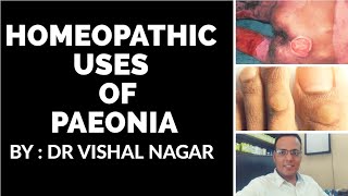 Homeopathic medicine PAEONIA for piles fistula fissure corns bunion and bed sores by Dr Vishal [upl. by Thin]