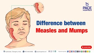 Measles and Mumps  Difference between Measles and Mumps  mumps measles [upl. by God918]