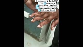 Rheumatoid Arthritis Late Stage mbbs [upl. by Charis]