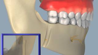 Sagittal Split Osteotomy [upl. by Acisse573]