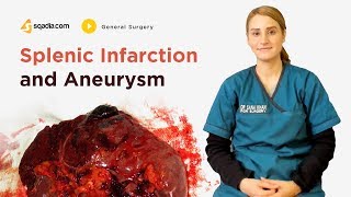 Splenic Infarction and Aneurysm  General Surgery Lectures  Student Education  VLearning [upl. by Calderon]